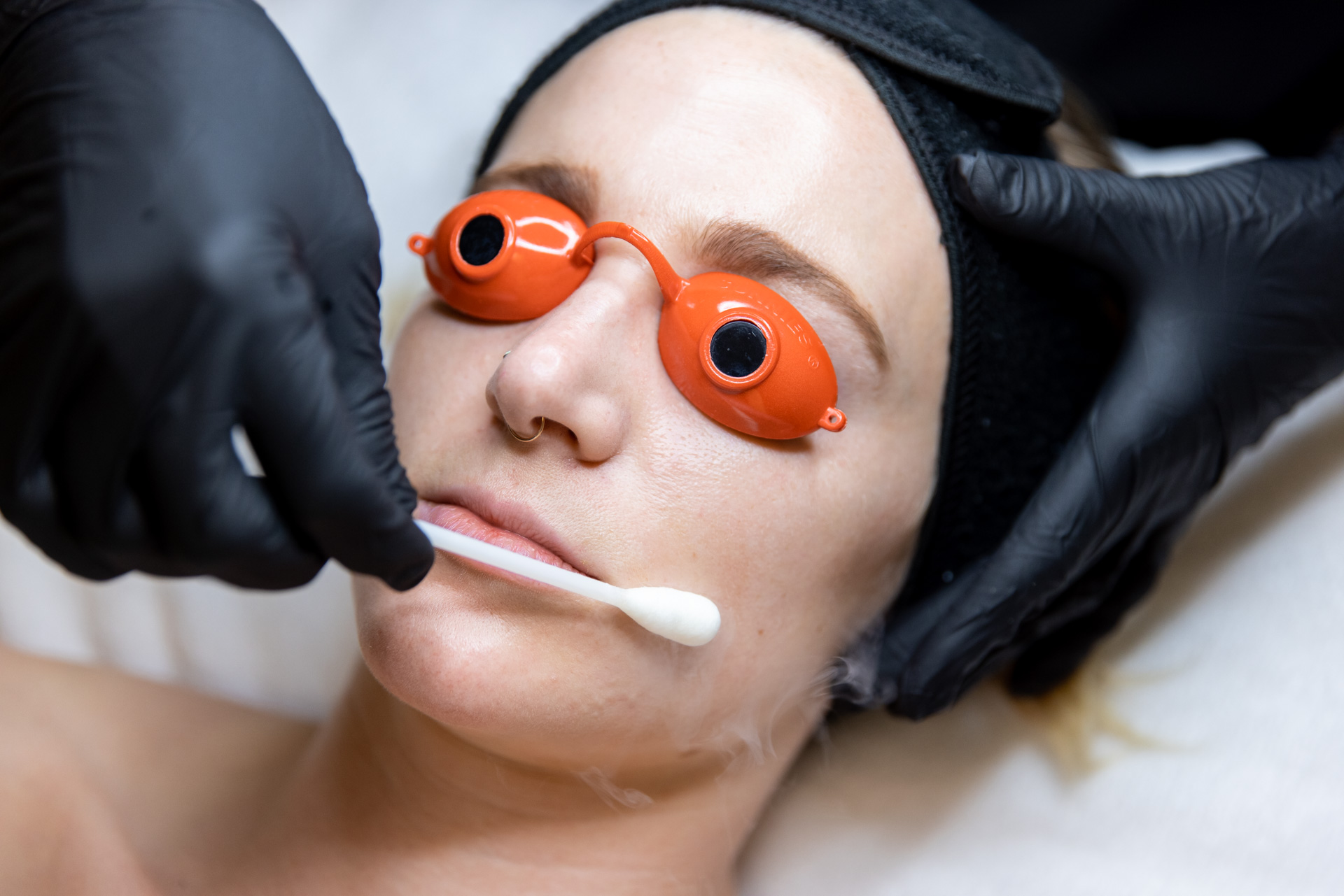 Woman wearing eye protection receives a chemical peel in San Jose
