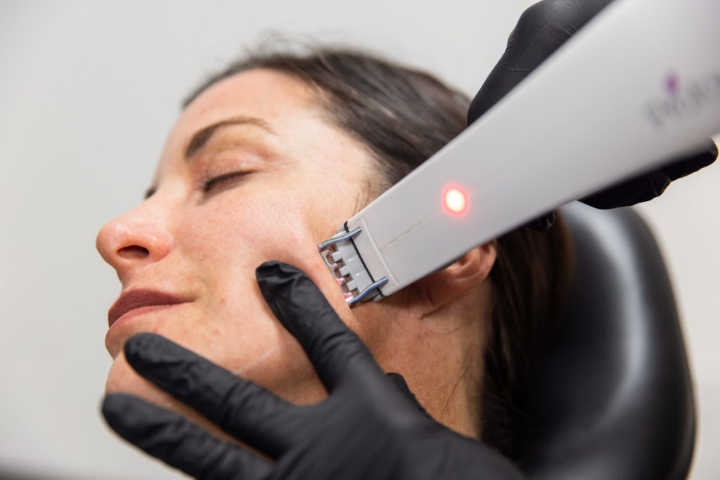 A woman gets a Profound skin tightening treatment for her face