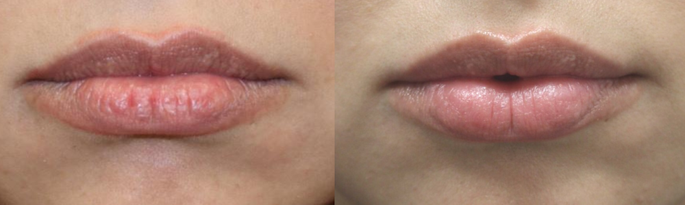 best lip treatments in Menlo Park: lip augmentation results