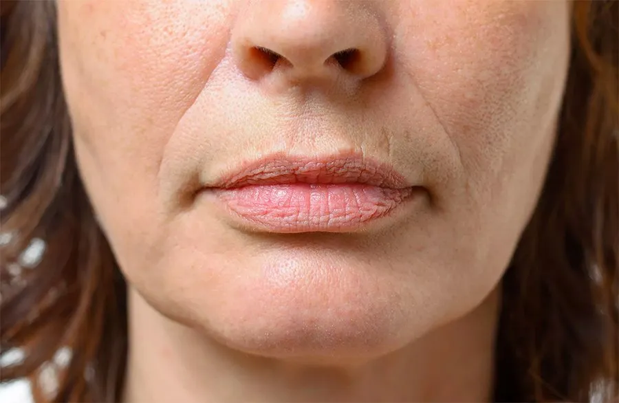 SkinTyte Laser can be used on the facial laxity like this.